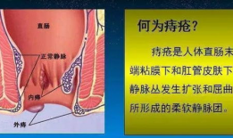 女性混合痔疮手术视频,女性混合痔疮手术过程解析与康复指导