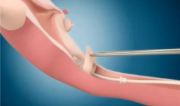 上环手术视频,专业视角下的操作步骤与注意事项