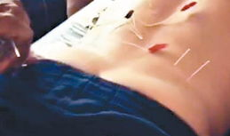 针灸视频,入门到精通的实用指南